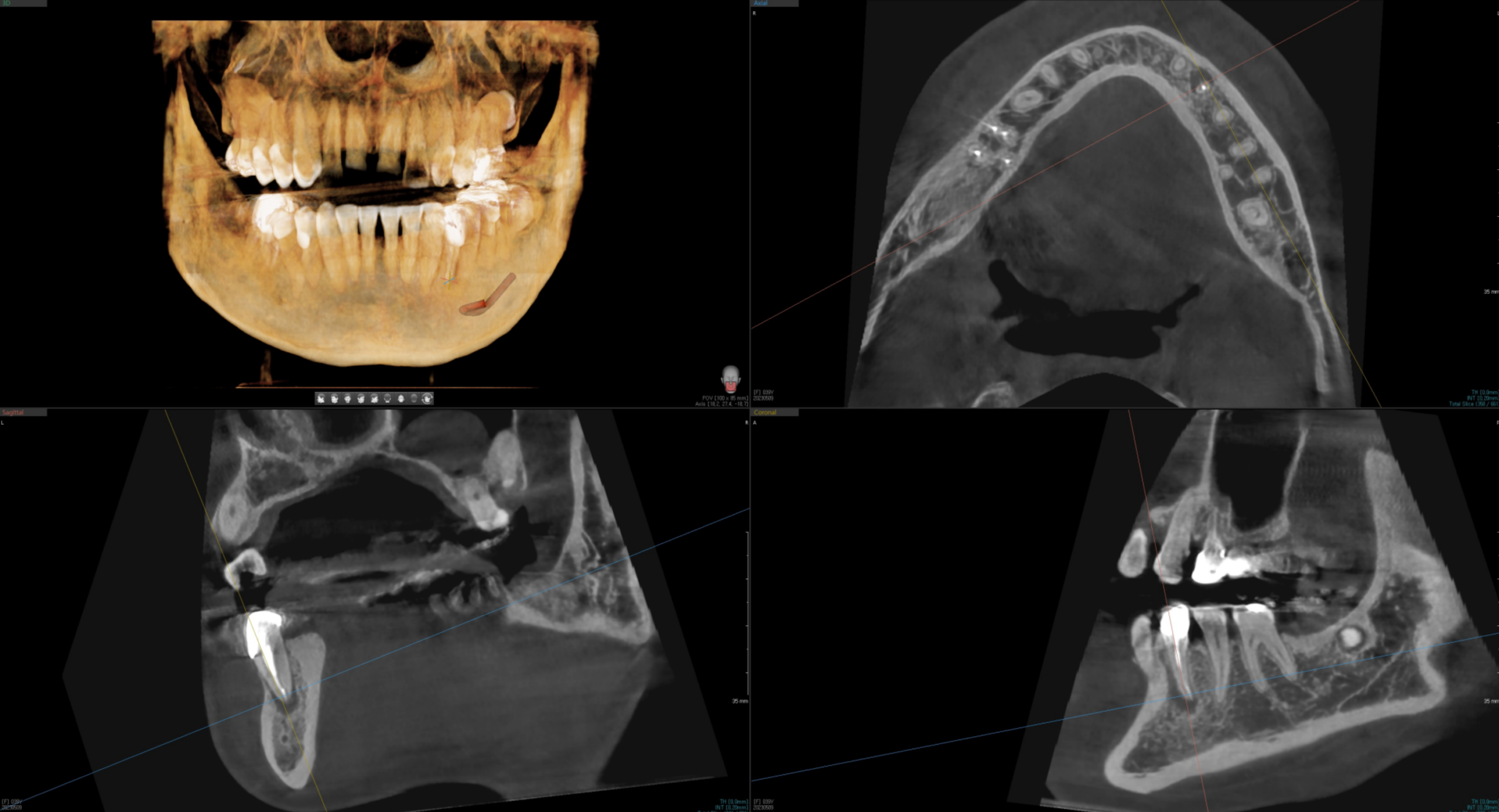 더에스플란트 정밀 CT 계획