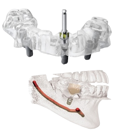 행궁동 치과 더에스플란트 CT 정밀계획