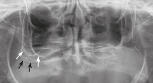 더에스플란트치과 CT 분석 경사식립
