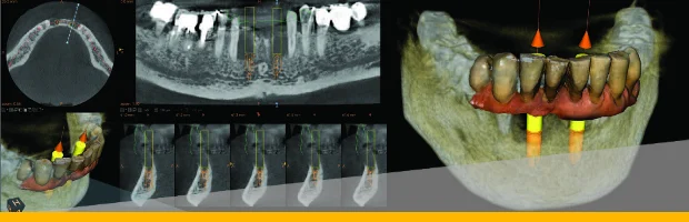 행궁동 치과 전치부 임플란트 CBCT 순측 치조골 분석