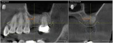 권선동 치과 더에스플란트 잔존골 높이 골밀도 CBCT 분석