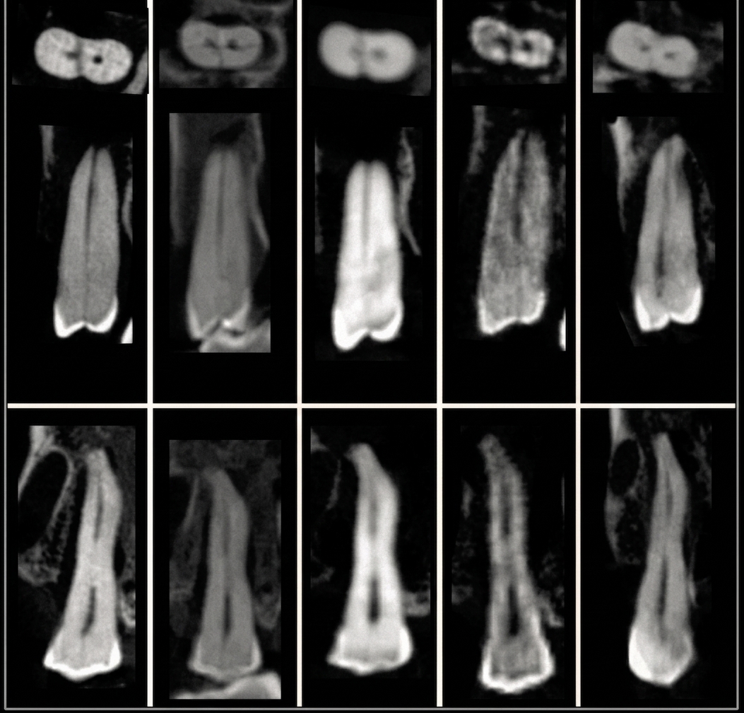 수원시청역 치과 더에스플란트 치아 파절 CBCT 진단