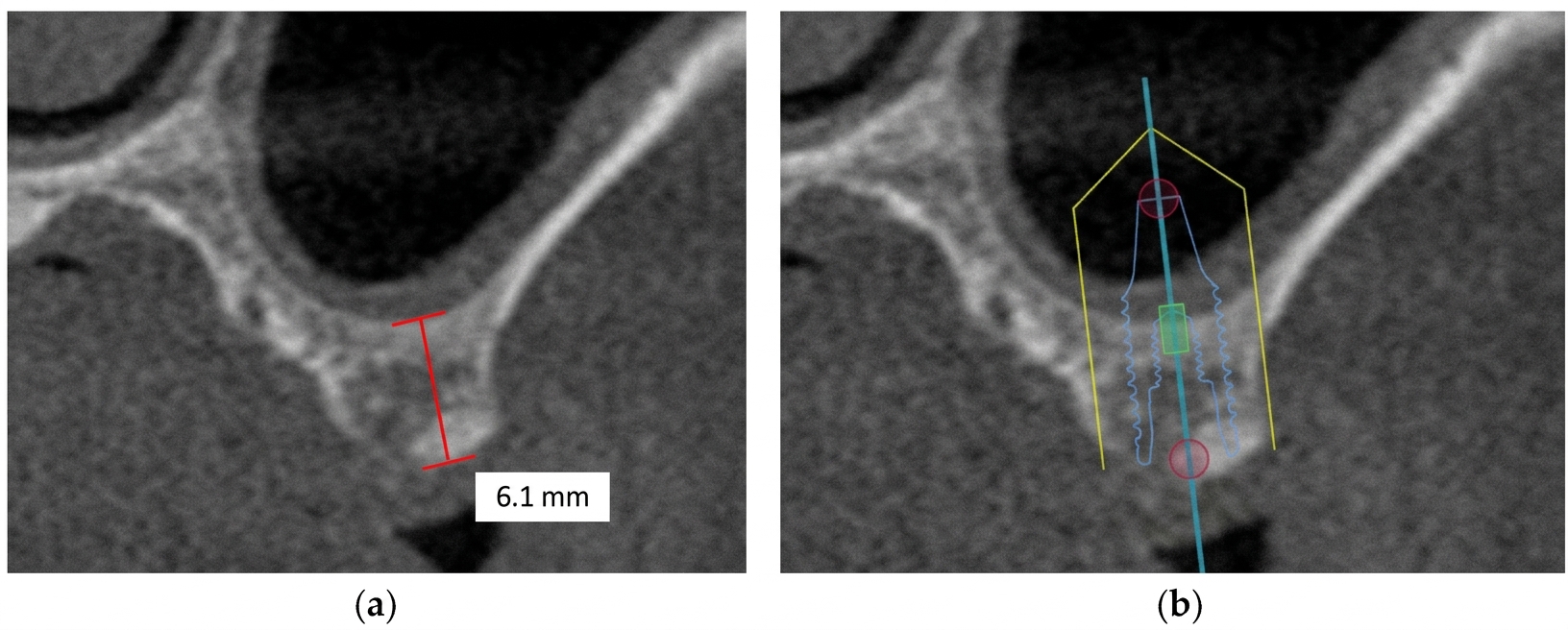 우만동 치과 더에스플란트 상악동 거상술 CBCT 진단
